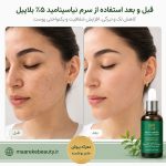 سرم نیاسینامید کاهش لک و جای جوش