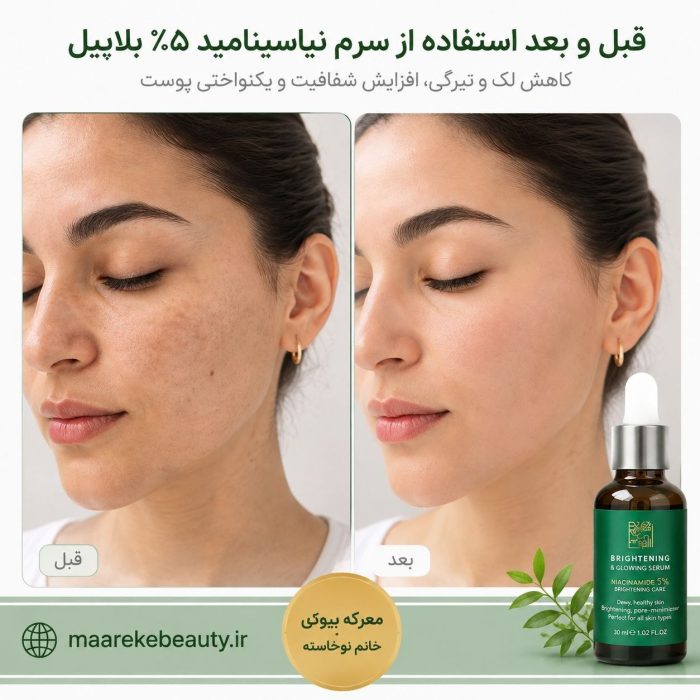 سرم نیاسینامید کاهش لک و جای جوش